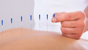 L'agopuntura